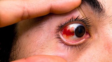 دلایل پارگی رگ در چشم و توصیه‌های درمانی