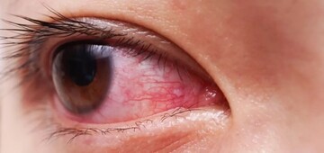 چرا چشم‌هایتان همیشه قرمزند و چه باید کرد؟