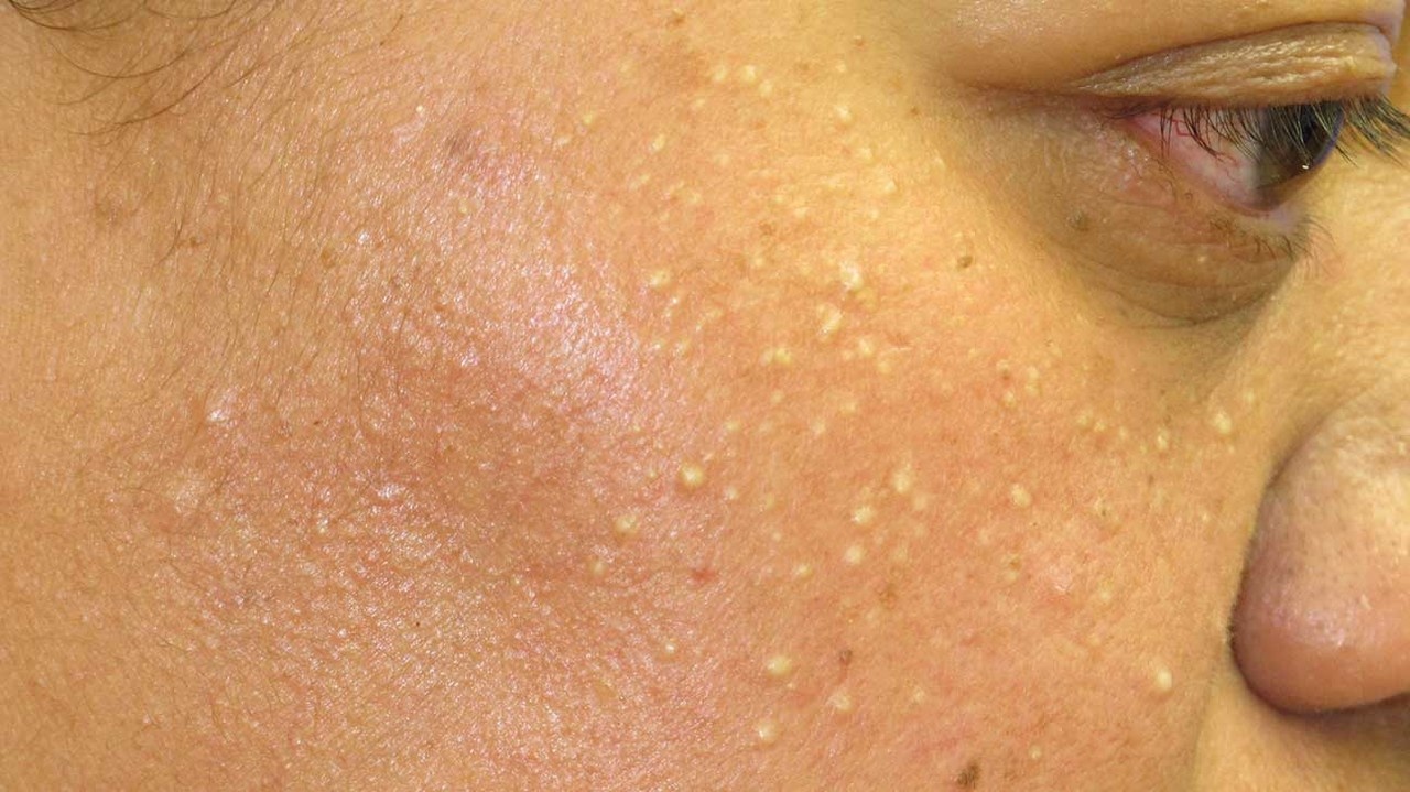 میلیا و علت‌های شایع آن را بشناسید