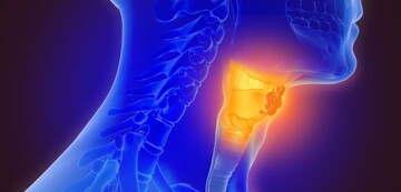 سرطان تیروئید و آنچه خوب است در مورد آن بدانید