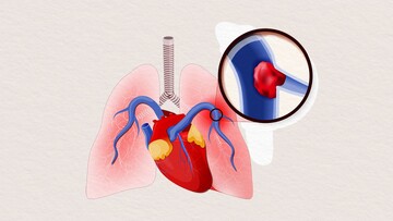 علائم، دلایل، عوارض، پیشگیری و درمان آمبولی ریه