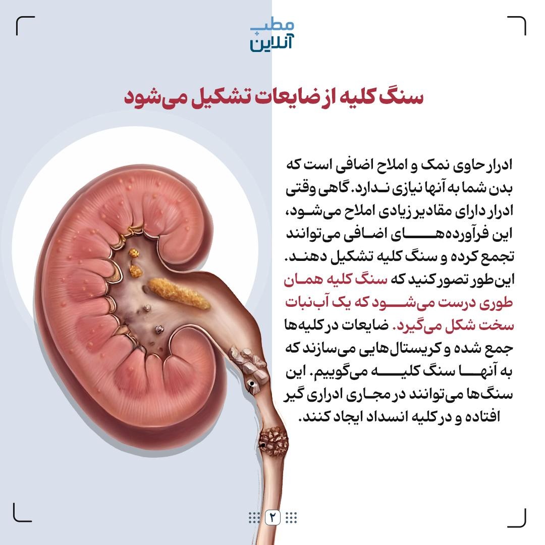 ۸ نکته در مورد سنگ کلیه که خوب است بدانید