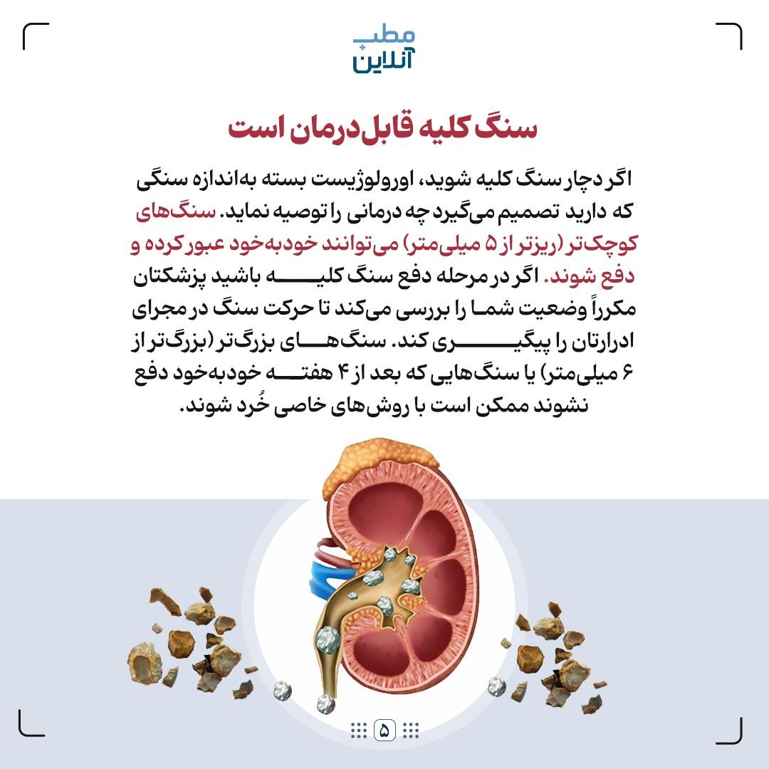 ۸ نکته در مورد سنگ کلیه که خوب است بدانید