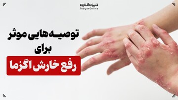 توصیه‌هایی مؤثر برای رفع خارش اگزما