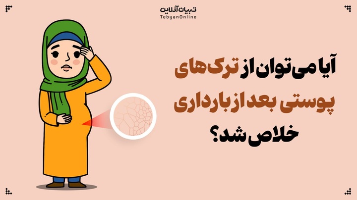 آیا می‌توان از ترک‌های پوستی بعد از بارداری خلاص شد؟