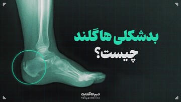 بدشکلی هاگلند چیست؟