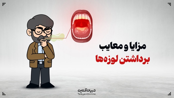 مزایا و معایب برداشتن لوزه‌ها