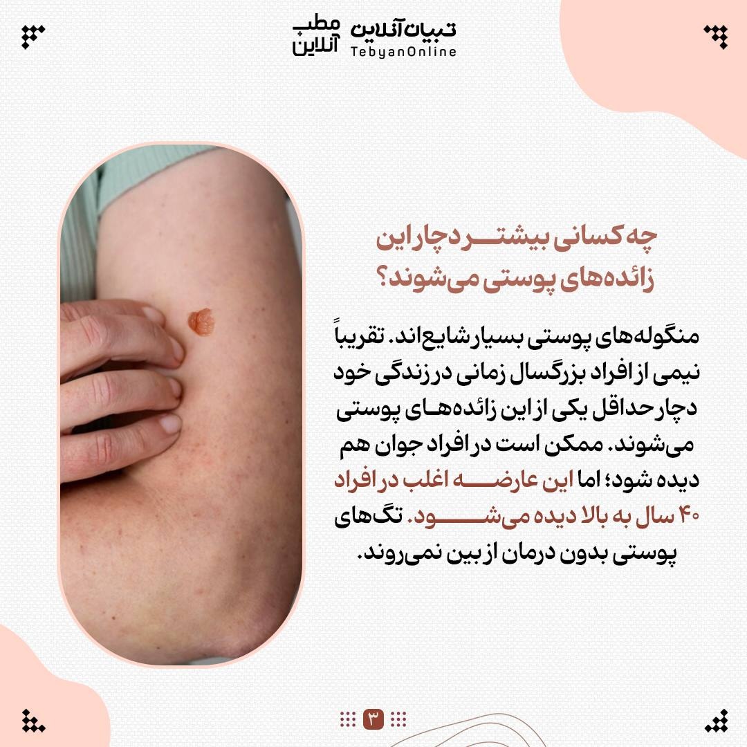 با منگوله‌های پوستی چه کنیم؟