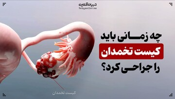 چه زمانی باید کیست تخمدان را جراحی کرد؟