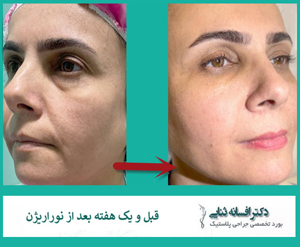 جوانسازی صورت، گردن و دستها با روش نوین نوراریژن