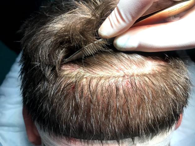 آیا کاشت مو درد دارد؟