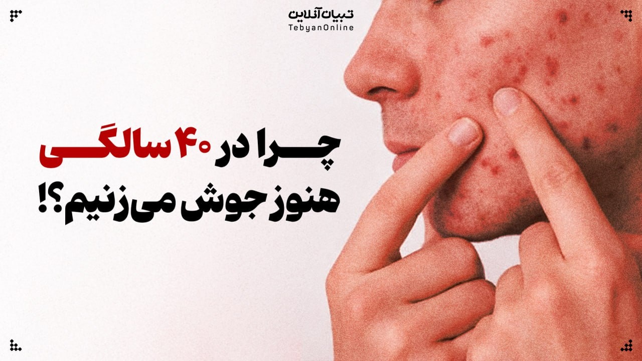 آکنه بزرگسالی | چرا در ۴۰ سالگی هنوز جوش میزنیم!؟ آکنه بزرگسالی | چرا در ۴۰ سالگی هنوز جوش میزنیم!؟