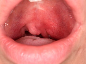 شایع‌ترین علائم و دلایل آبسه لوزه