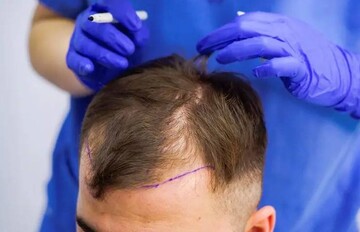 چرا ریزش مو در ناحیه شقیقه بیشتر دیده می‌شود و آیا کاشت مو راه‌حل مناسبی است؟