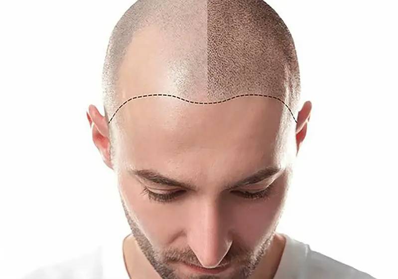 چرا ریزش مو در ناحیه شقیقه بیشتر دیده می‌شود و آیا کاشت مو راه‌حل مناسبی است؟