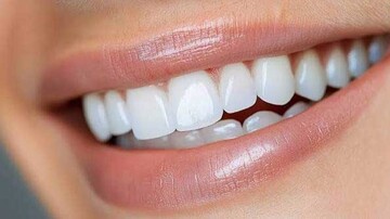 لمینت سرامیکی چگونه ساخته می‌شود و چه مزایایی دارد؟