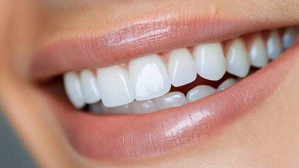 لمینت سرامیکی چگونه ساخته می‌شود و چه مزایایی دارد؟
