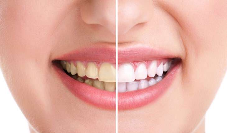 سفید شدن لثه‌ها نشانه چیست؟