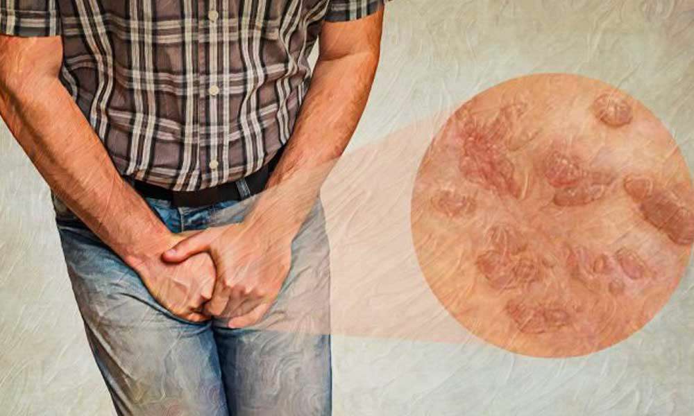  نشانه ها و انواع بیماری های مقاربتی