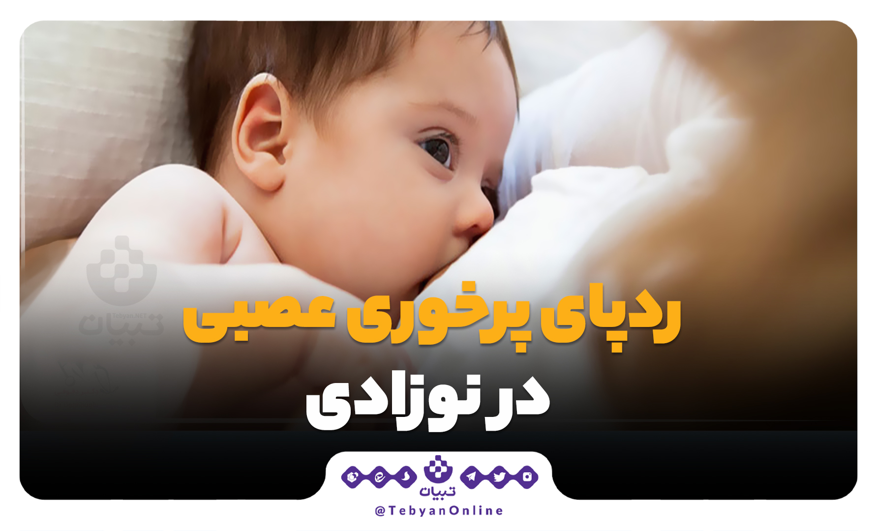 ردپای پرخوری عصبی در نوزادی