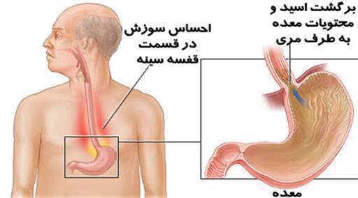 6 نشانه خاموش ترش کردن معده