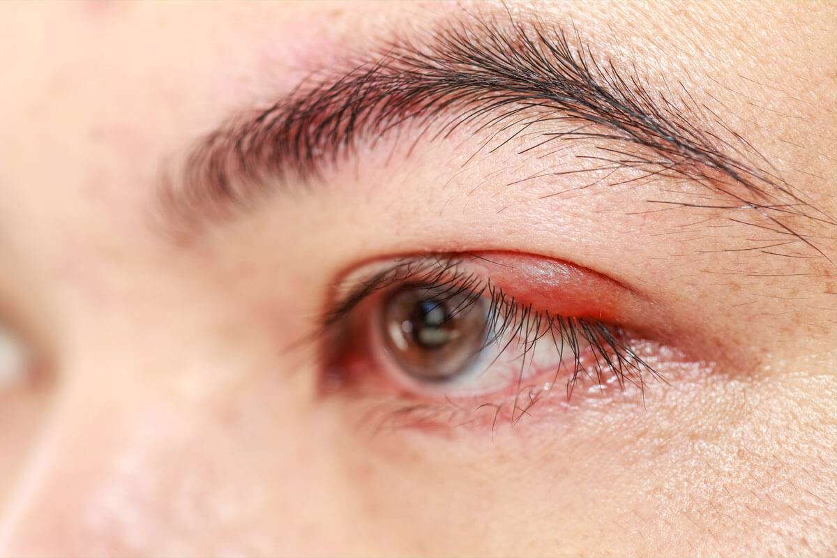 گل مژه و راه‌های درمان آن