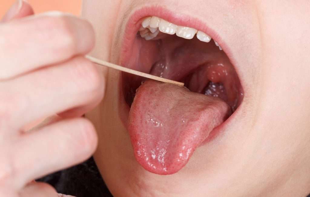 التهاب لوزه و آنچه باید در مورد آن بدانید التهاب لوزه و آنچه باید در مورد آن بدانید