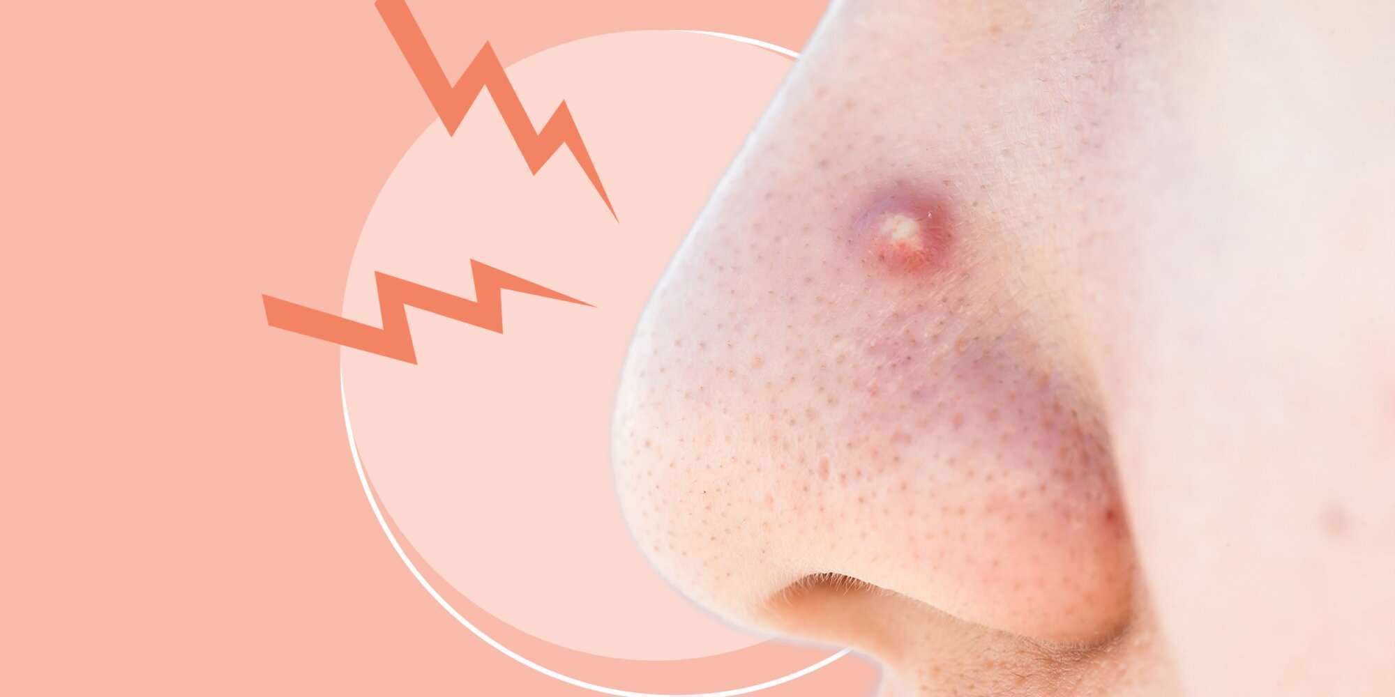 با جوش‌های روی بینی چه کنیم؟