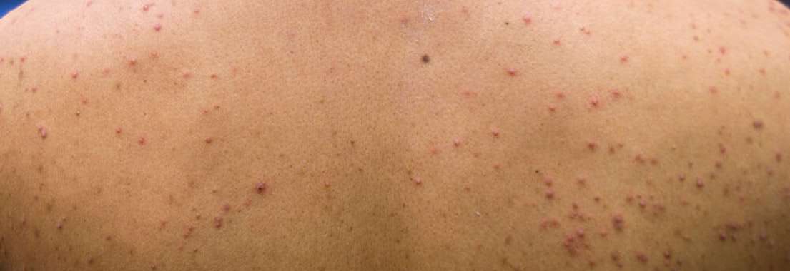 آکنه قارچی چیست و چگونه درمان میشود؟ آکنه قارچی چیست و چگونه درمان میشود؟
