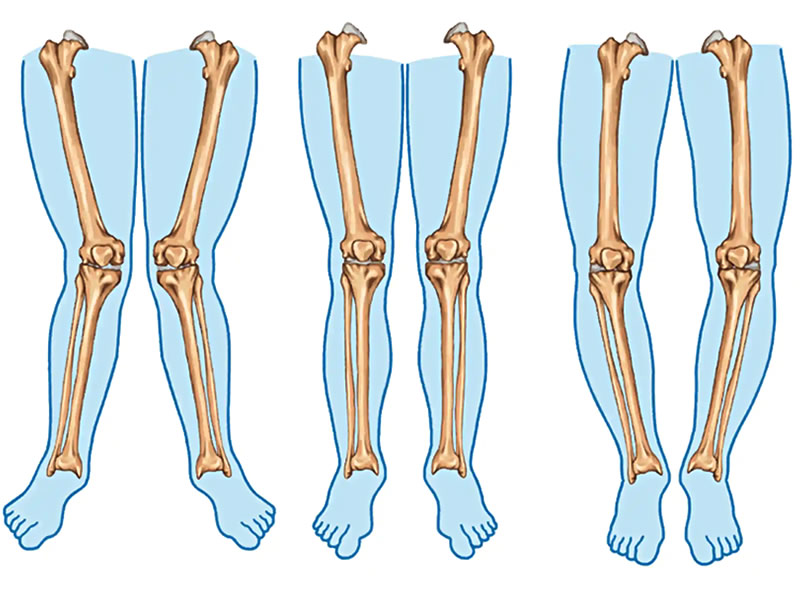 پا پرانتزی در کودکان و بزرگسالان