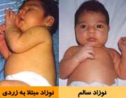 تاثير زردي کودک بر شنوايي او