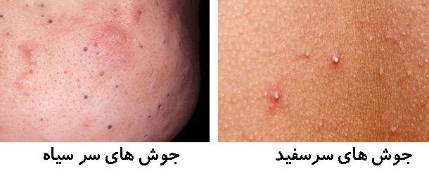به این جوشها دست نزنید!