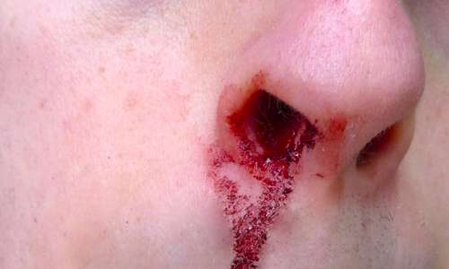 خون‌دماغ مکرر گاهی خطرناک است