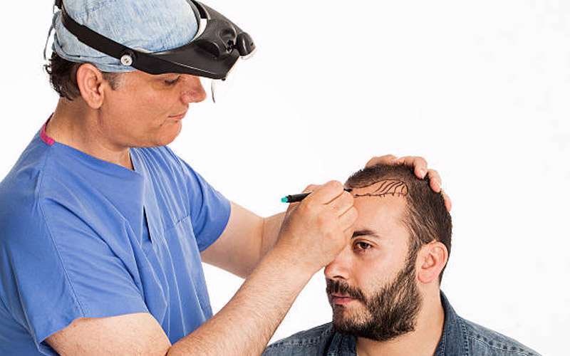 بیشتر بدانید؛ کاشت مو
