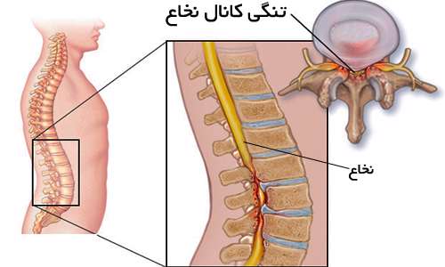 تنگ شدن کانال نخاع؛ علائم و درمان