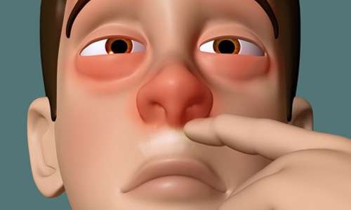10 نهی پس از جراحی بینی
