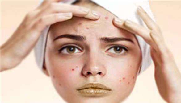 راهکارهایی برای از بین بردن جوش و جای جوش 