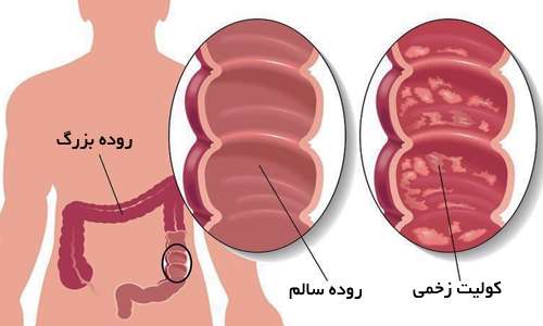 وقتی دیواره روده زخم می‌شود