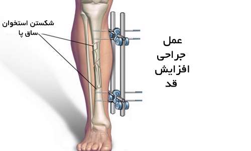 قدبلندهای ساختگی