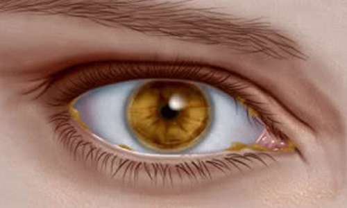 آنچه ترشحات چشم از سلامت شما فاش می‌کند