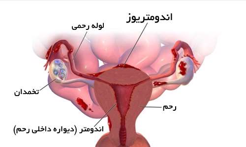 درد قاعدگی بعد از روز سوم را جدی بگیرید