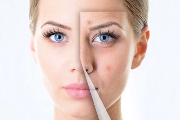 صورت های جوش دار اینگونه آرایش کنید 