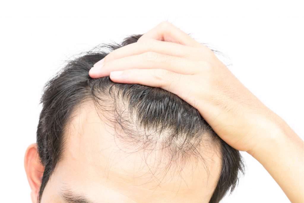  گاه موها عزم رفتن می‌کنند