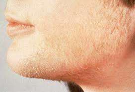  پرمویی صورت خانم ها چیست؟ 