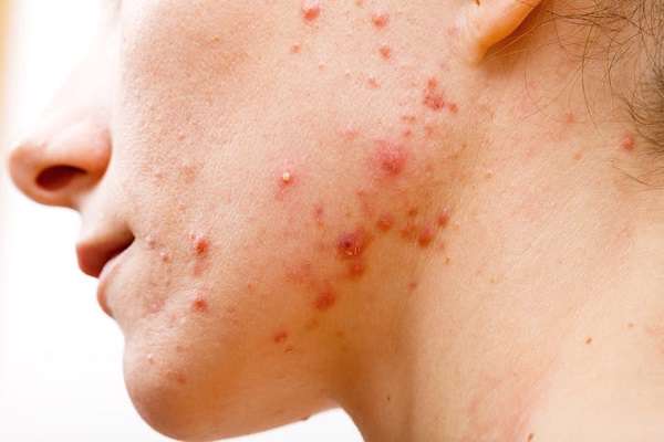 ظهور آکنه در هر قسمت بدن نشانه چیست؟