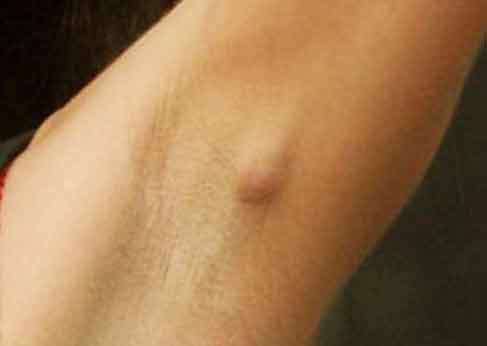 دلایل تورم غدد لنفاوی زیر بغل