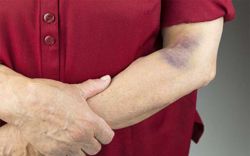 چرا به راحتی دچار کبودی می‌شویم