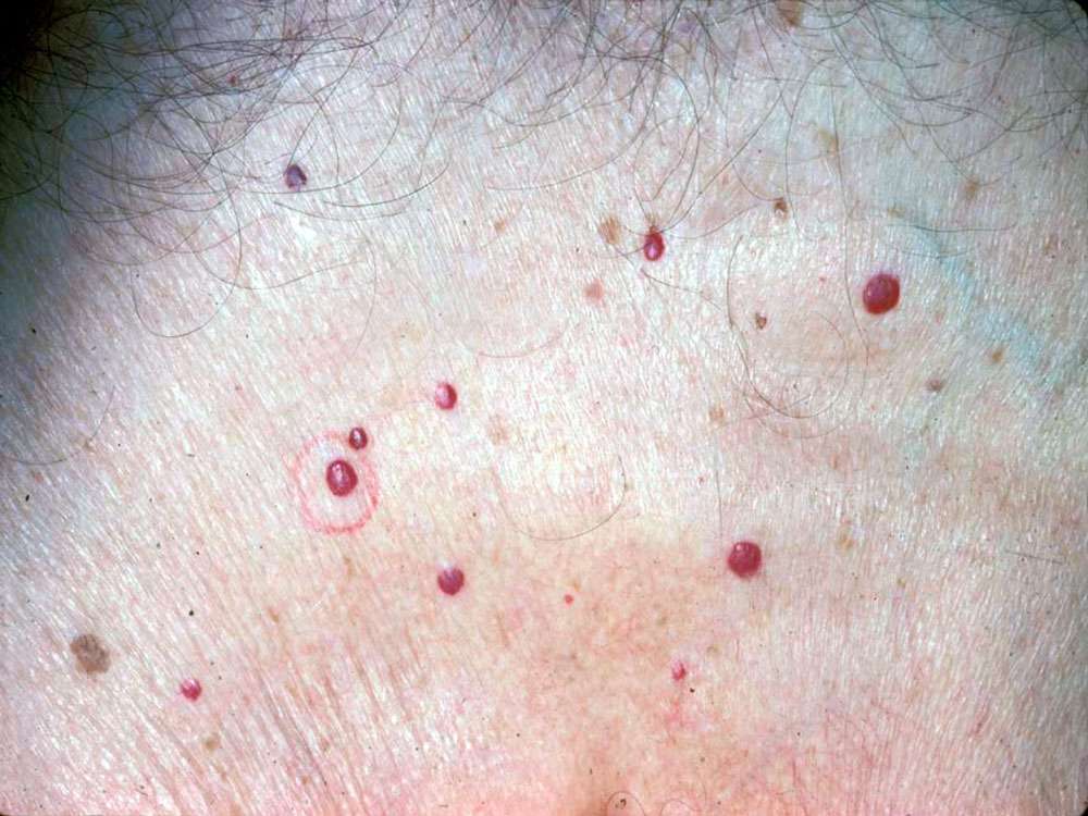 شرایط نگران کننده پوستی پس از 40 سالگی