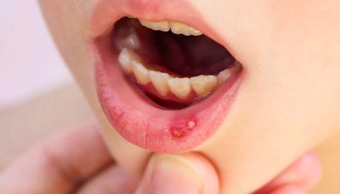 راهکارهای خانگی برای تسکین تبخال در کودکان