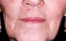 پیری پوست و روش های پیشگیری یا تعدیل آن